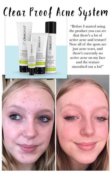 Mary Kay Clear Proof® Acne System Set – Clear Skin Starts Here